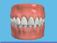 dental-bridge-restoration